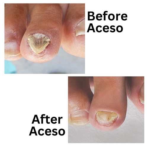 Aceso Before after 2